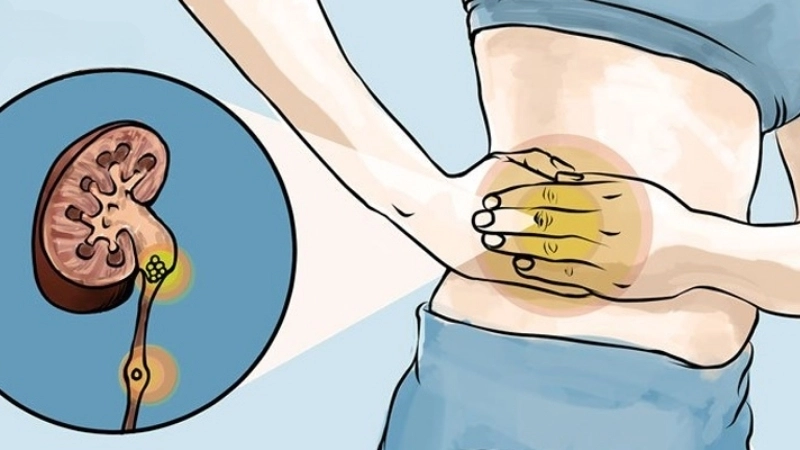 Sỏi niệu quản là gì?