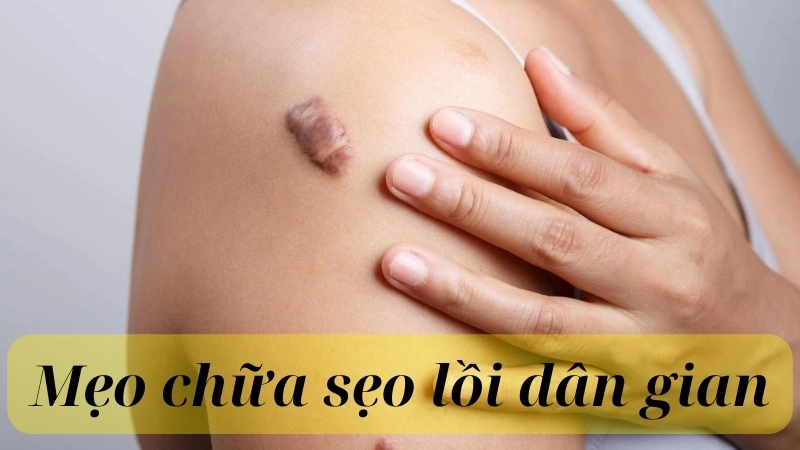 Các mẹo chữa sẹo lồi dân gian đơn giản mà hiệu quả