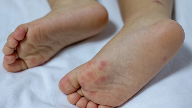Khi nào cần đưa trẻ bị tay chân miệng đến cơ sở y tế?