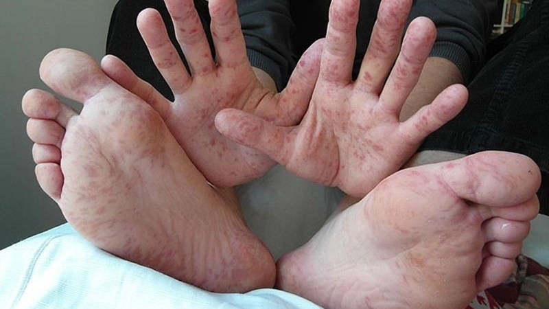 Lưu ý quan trọng khi áp dụng mẹo dân gian chữa bệnh chân tay miệng