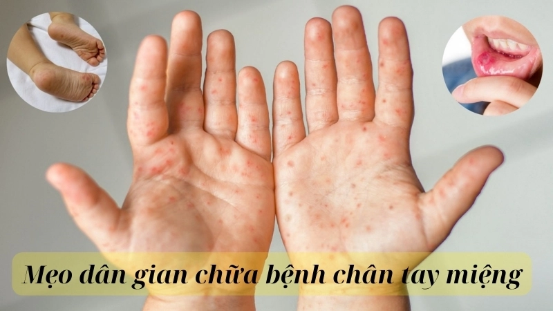 Mẹo dân gian chữa bệnh chân tay miệng hiệu quả