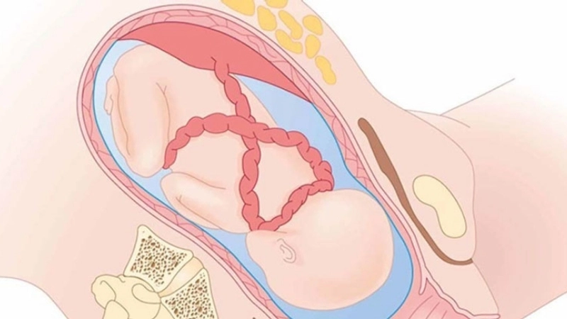 Dây rốn quấn cổ là gì?