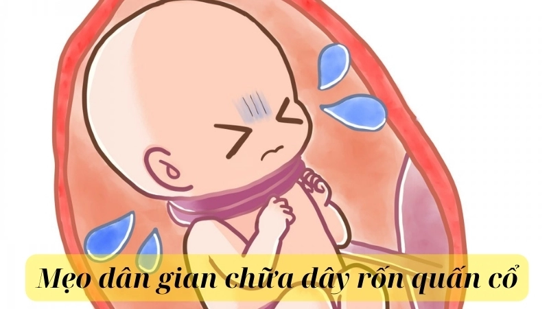 Mẹo dân gian chữa dây rốn quấn cổ