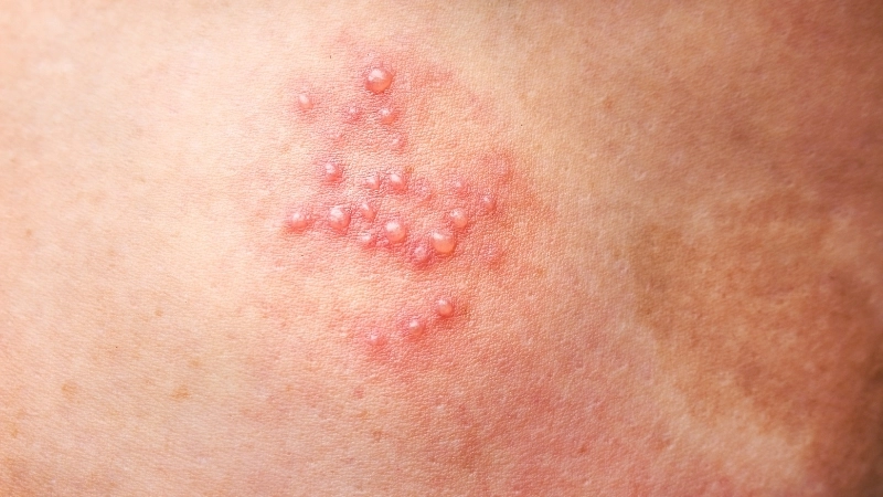 Giời leo là một bệnh lý ngoài da gây ra bởi virus herpes zoster 