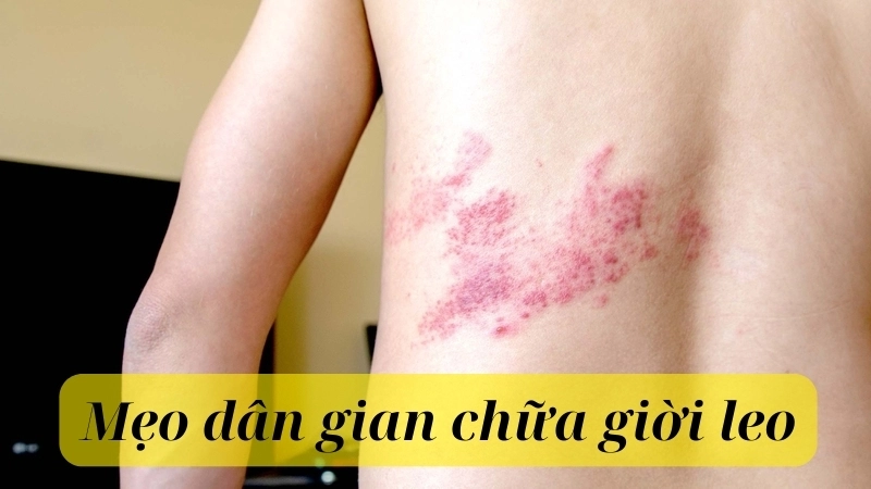 Cách chữa giời leo dân gian đơn giản mà hiệu quả