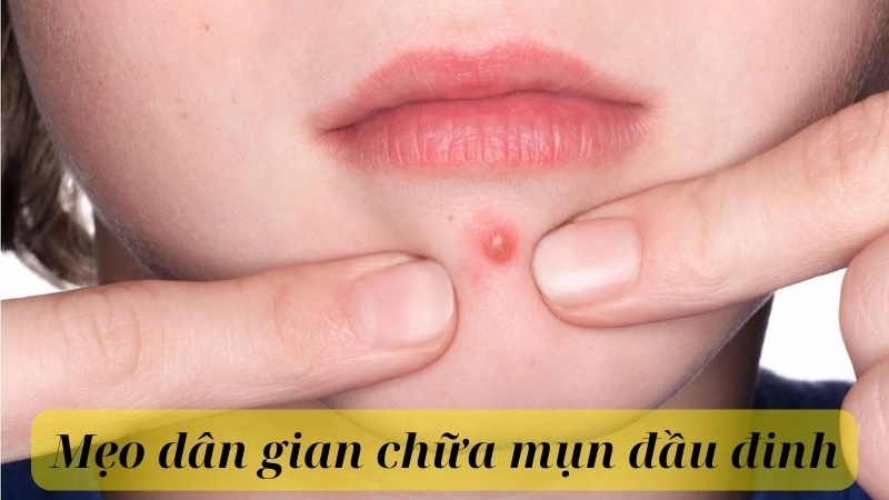 Cách trị mụn đầu đinh dân gian hiệu quả 