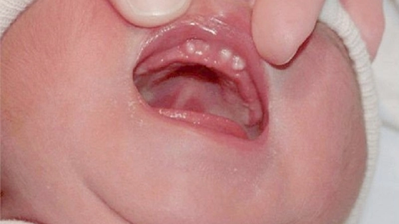 Nanh sữa ở trẻ sơ sinh là gì?