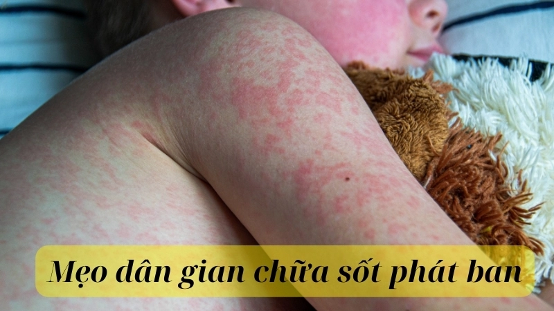 Mẹo dân gian chữa sốt phát ban hiệu quả tại nhà