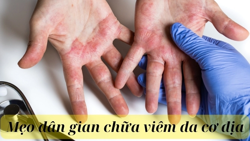 Mẹo dân gian chữa viêm da cơ địa từ thảo dược tự nhiên