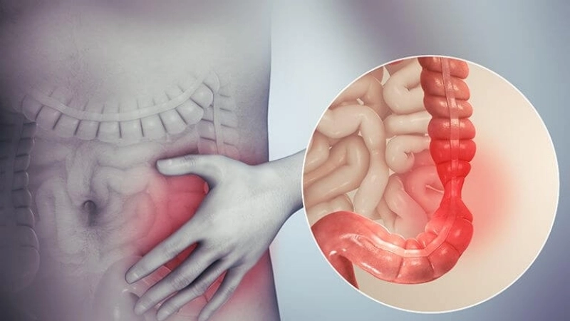 Viêm đại tràng là bệnh lý phổ biến xuất phát từ nhiều nguyên nhân khác nhau