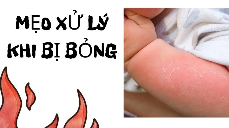 Các bước sơ cứu ban đầu khi bị bỏng nhẹ