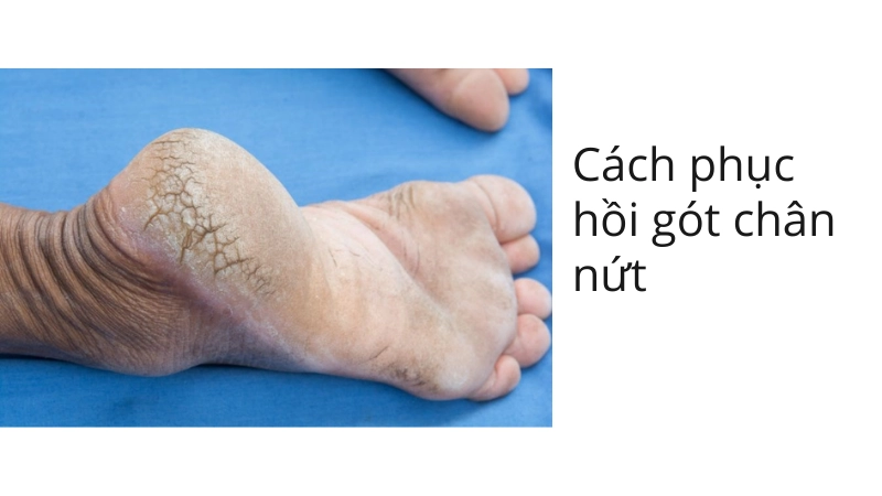 Quy trình phục hồi gót chân nứt nẻ tại nhà